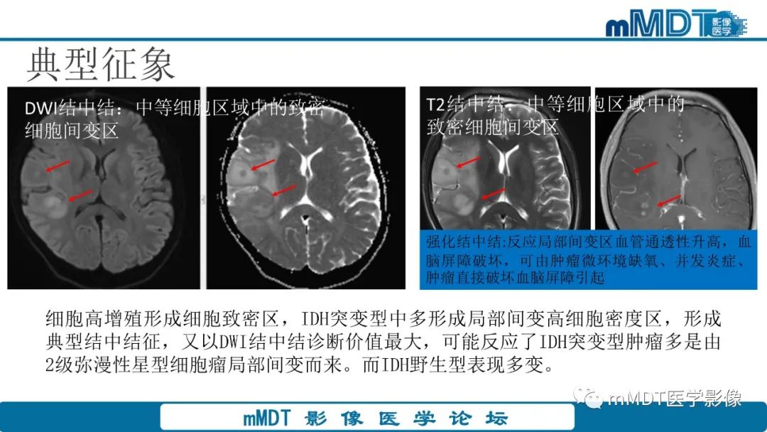 影像PPT - 【PPT】星形细胞瘤的新认识-23