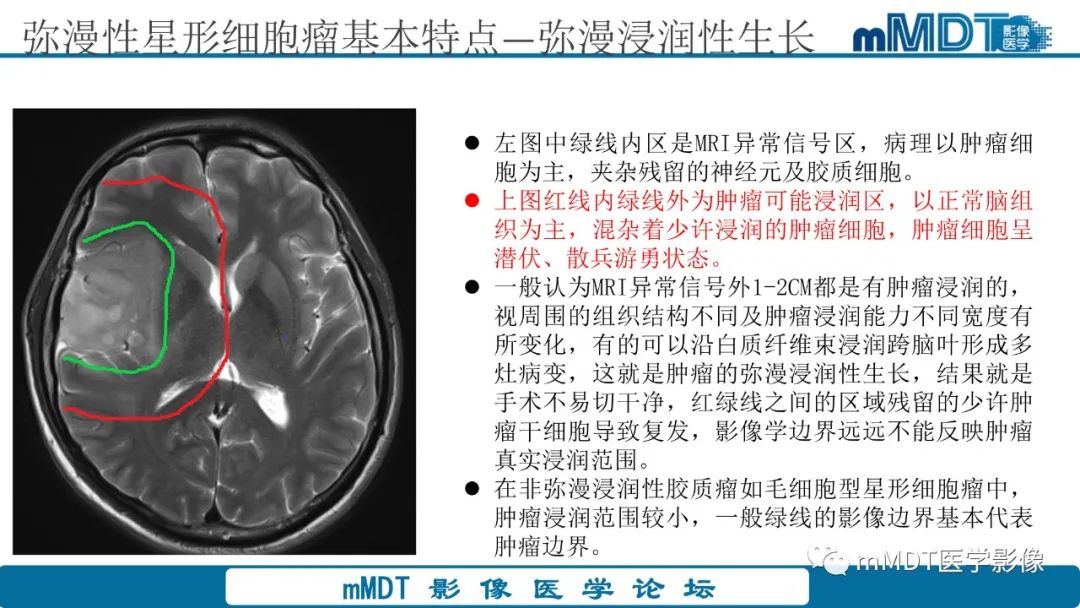 影像PPT - 【PPT】星形细胞瘤的新认识-24