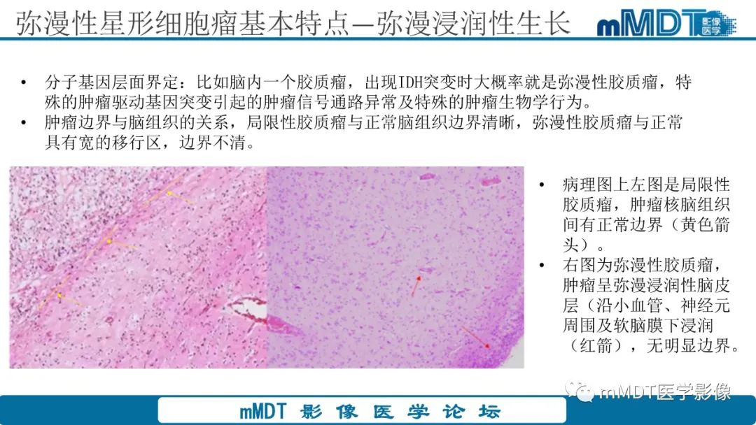 影像PPT - 【PPT】星形细胞瘤的新认识-25