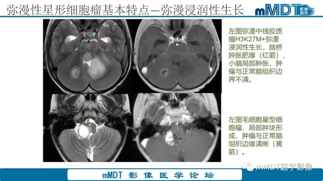 影像PPT - 【PPT】星形细胞瘤的新认识-26