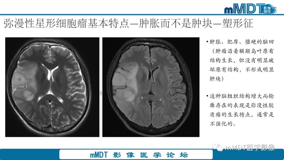 影像PPT - 【PPT】星形细胞瘤的新认识-28
