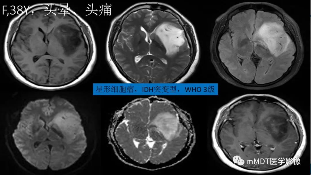 影像PPT - 【PPT】星形细胞瘤的新认识-32