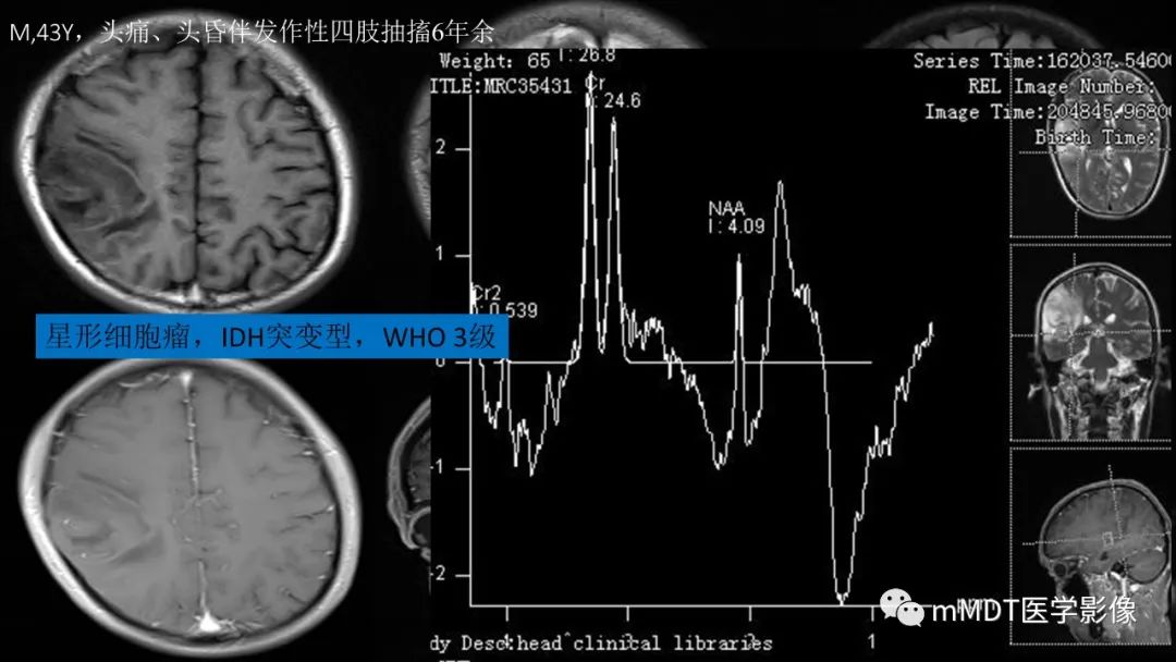 影像PPT - 【PPT】星形细胞瘤的新认识-33