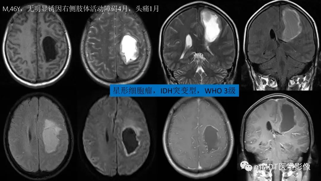 影像PPT - 【PPT】星形细胞瘤的新认识-34