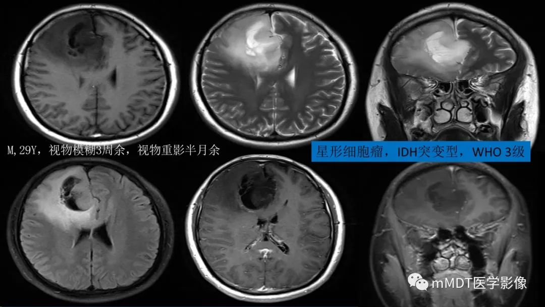 影像PPT - 【PPT】星形细胞瘤的新认识-35