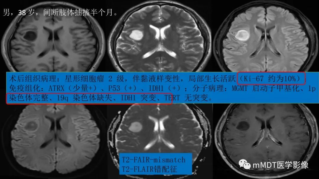 影像PPT - 【PPT】星形细胞瘤的新认识-36