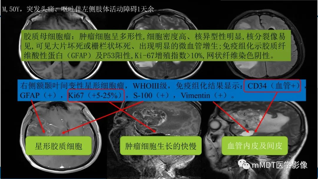 影像PPT - 【PPT】星形细胞瘤的新认识-42