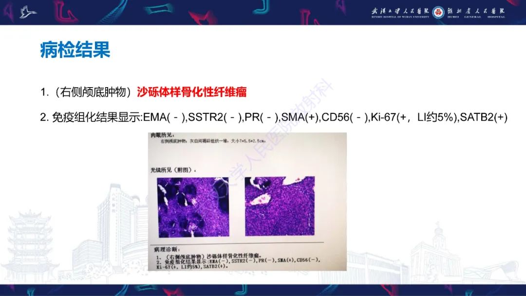 影像PPT - 【PPT】颌面部骨化性纤维瘤影像诊断-6