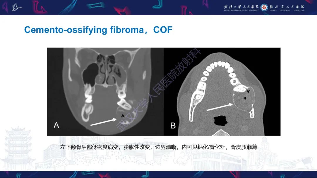 影像PPT - 【PPT】颌面部骨化性纤维瘤影像诊断-14