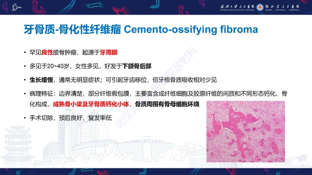 影像PPT - 【PPT】颌面部骨化性纤维瘤影像诊断-12