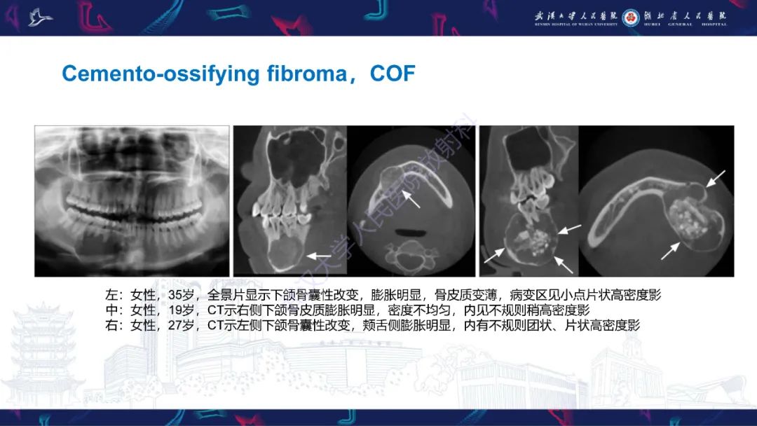 影像PPT - 【PPT】颌面部骨化性纤维瘤影像诊断-15