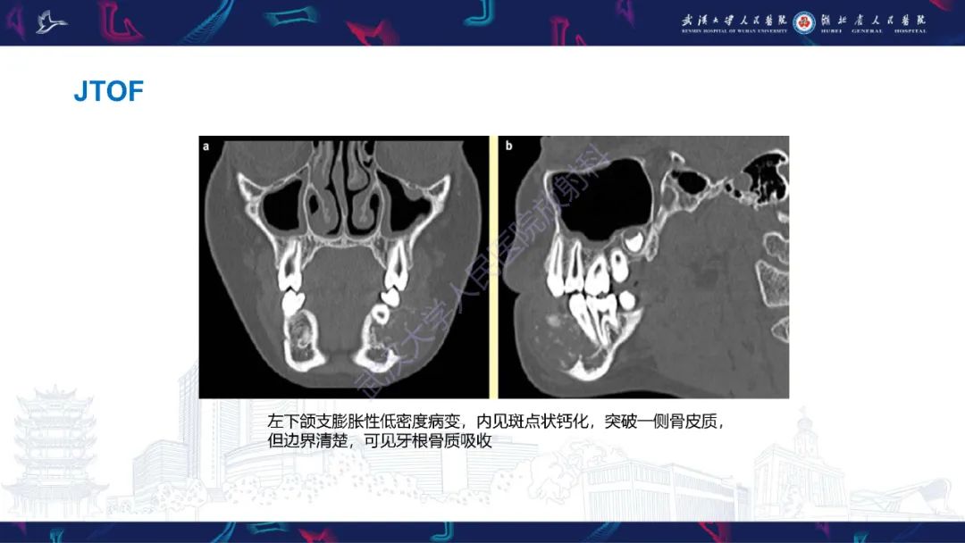 影像PPT - 【PPT】颌面部骨化性纤维瘤影像诊断-18