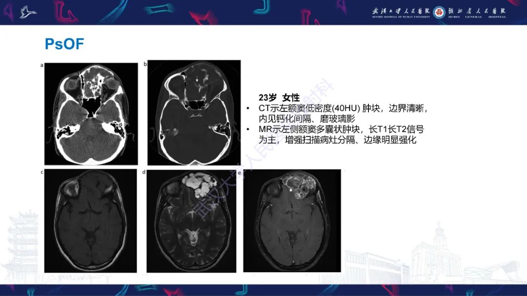 影像PPT - 【PPT】颌面部骨化性纤维瘤影像诊断-21