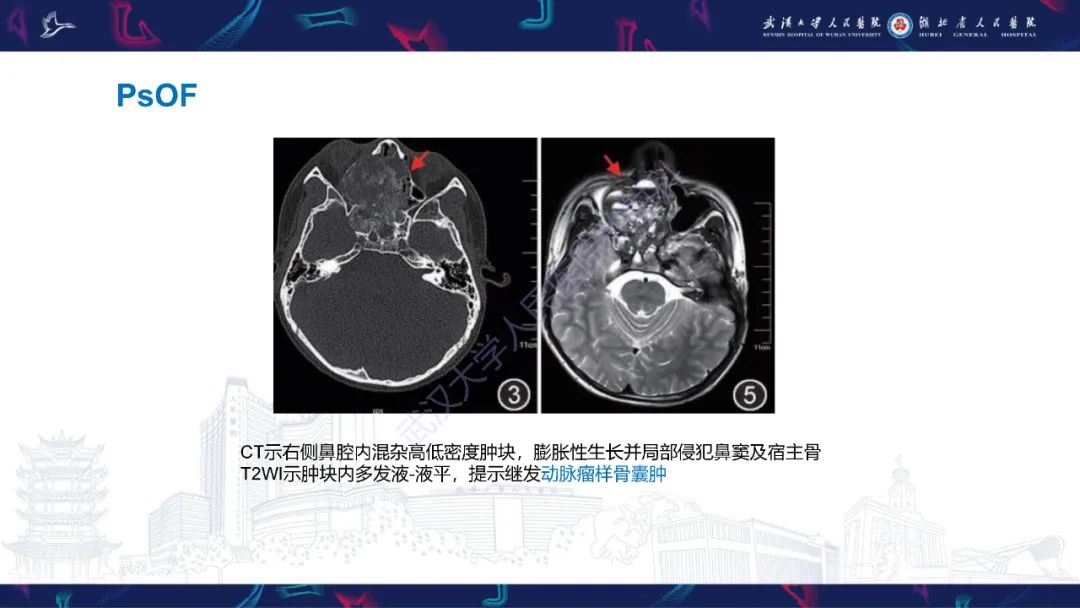 影像PPT - 【PPT】颌面部骨化性纤维瘤影像诊断-22