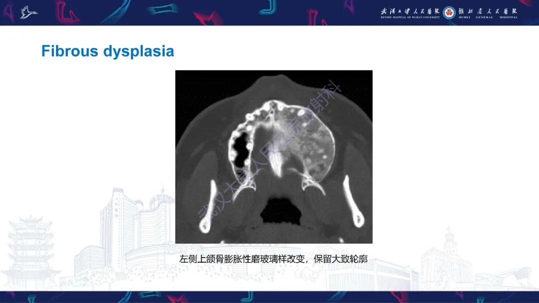 影像PPT - 【PPT】颌面部骨化性纤维瘤影像诊断-27
