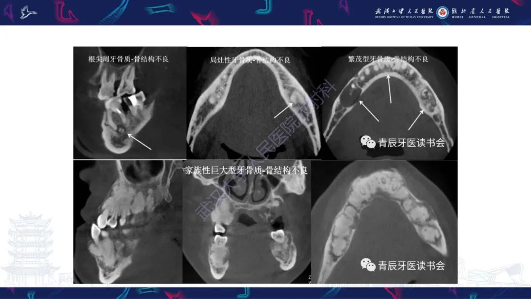 影像PPT - 【PPT】颌面部骨化性纤维瘤影像诊断-29