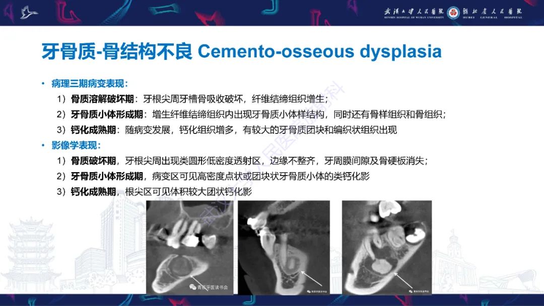 影像PPT - 【PPT】颌面部骨化性纤维瘤影像诊断-30