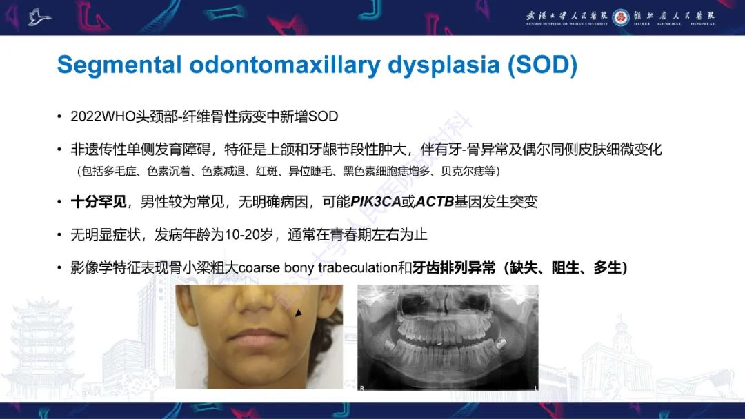 影像PPT - 【PPT】颌面部骨化性纤维瘤影像诊断-32
