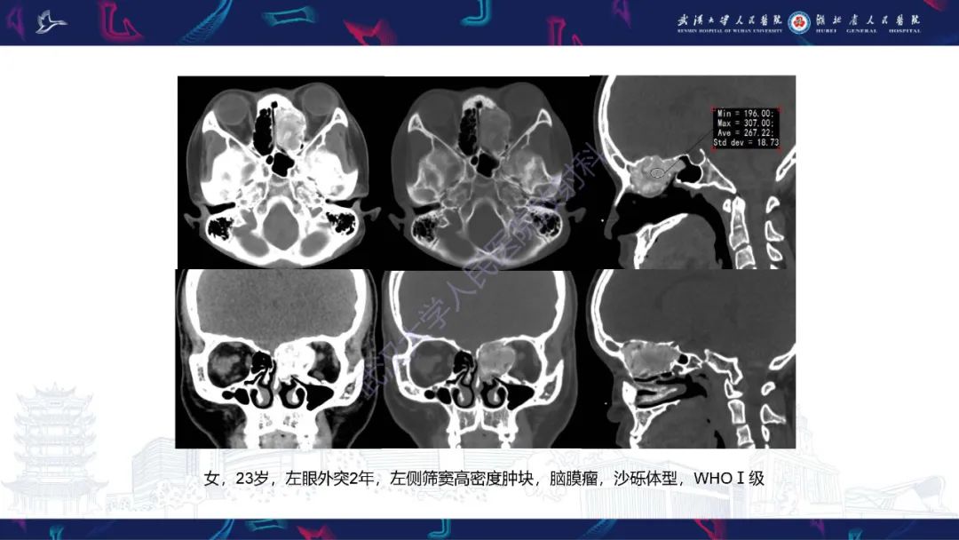 影像PPT - 【PPT】颌面部骨化性纤维瘤影像诊断-34