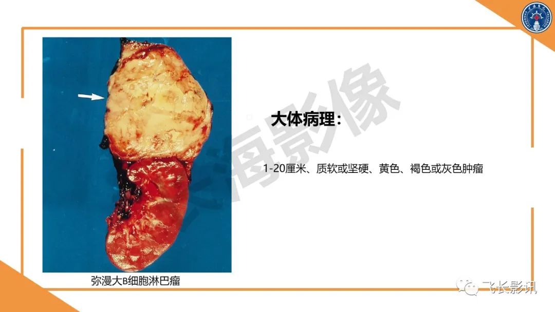 影像PPT - 【PPT】原发性肾淋巴瘤的影像诊断-7