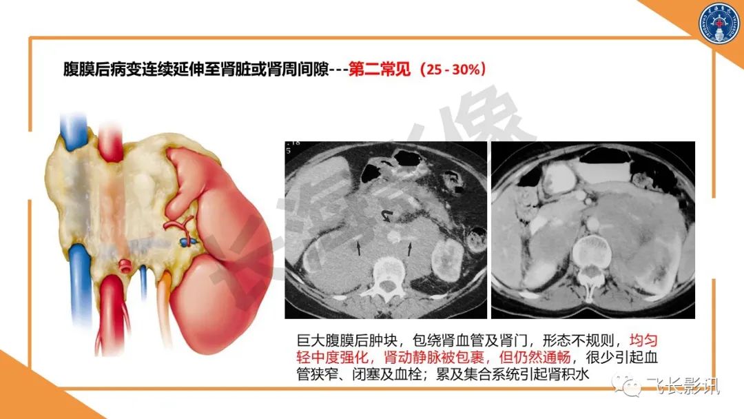 影像PPT - 【PPT】原发性肾淋巴瘤的影像诊断-17