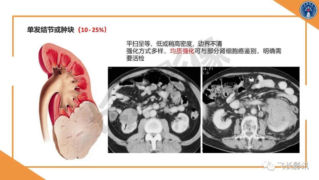 影像PPT - 【PPT】原发性肾淋巴瘤的影像诊断-18
