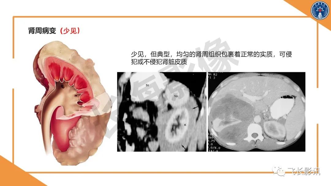 影像PPT - 【PPT】原发性肾淋巴瘤的影像诊断-19