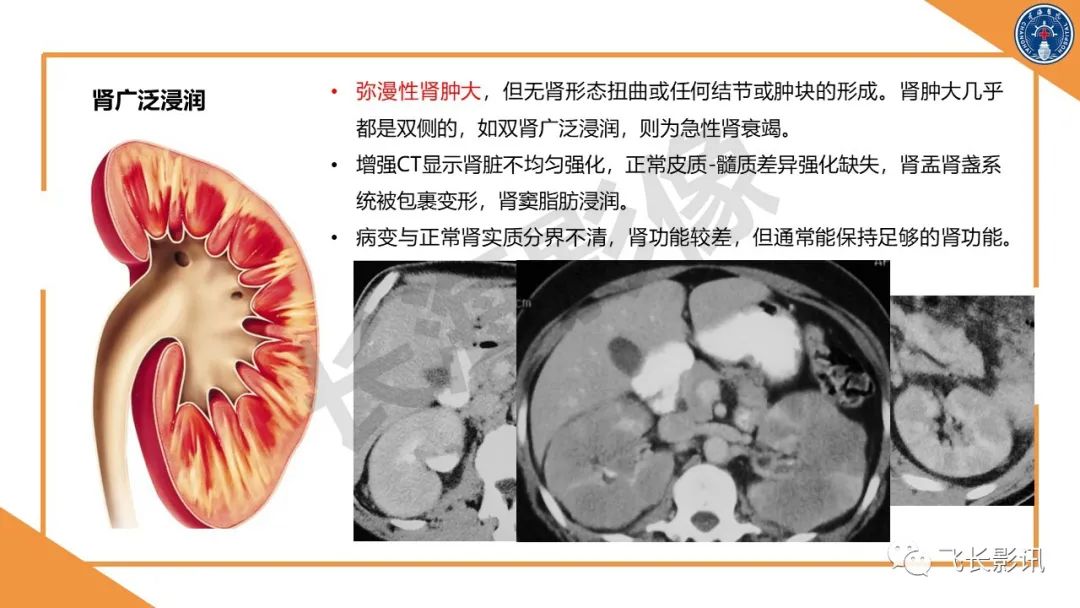 影像PPT - 【PPT】原发性肾淋巴瘤的影像诊断-20