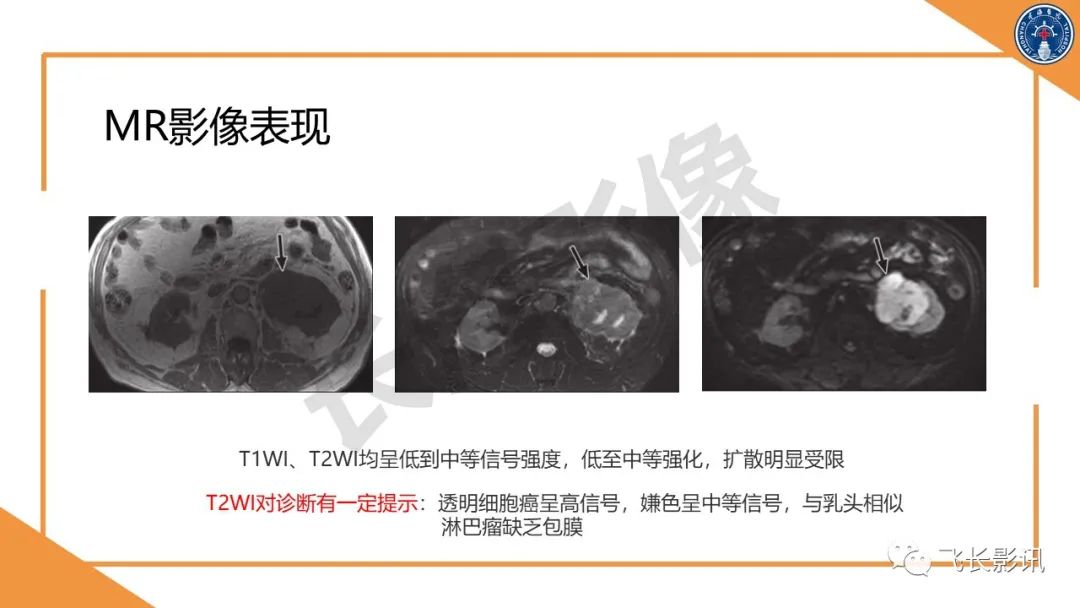 影像PPT - 【PPT】原发性肾淋巴瘤的影像诊断-21
