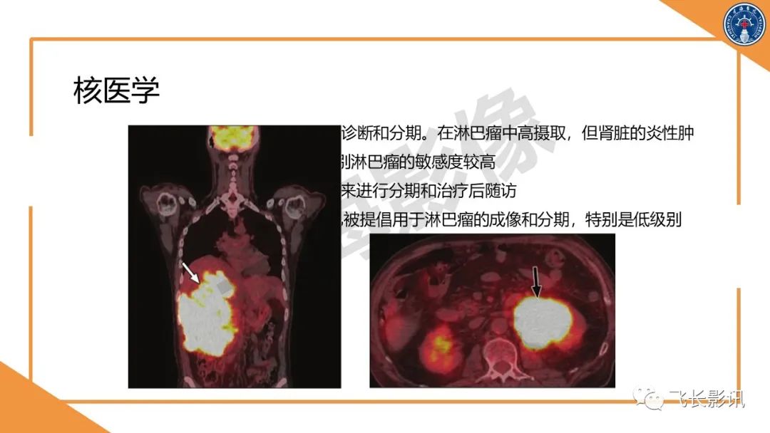 影像PPT - 【PPT】原发性肾淋巴瘤的影像诊断-23