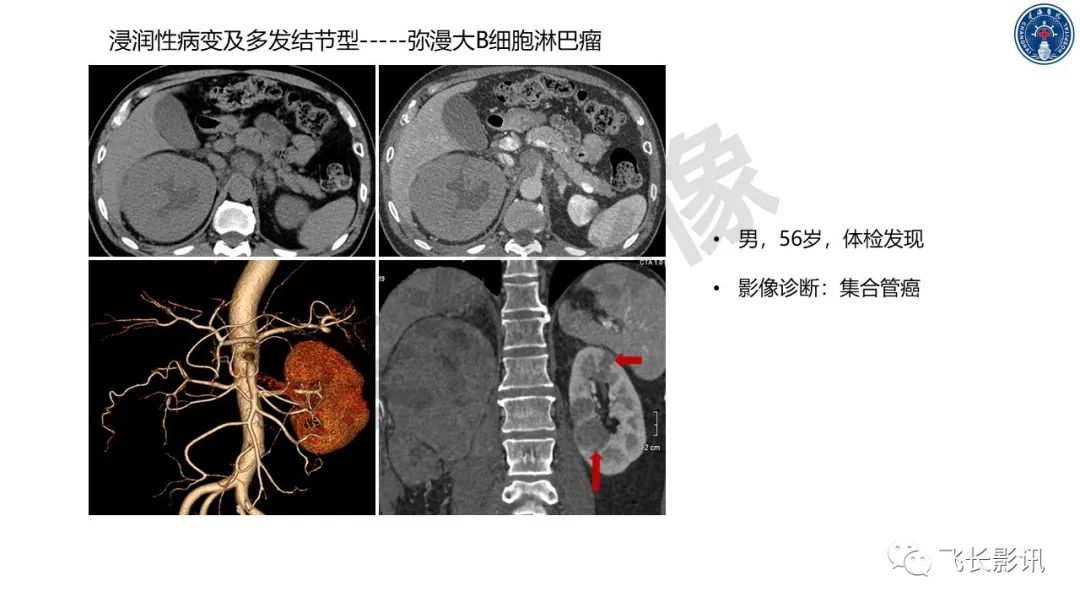 影像PPT - 【PPT】原发性肾淋巴瘤的影像诊断-32