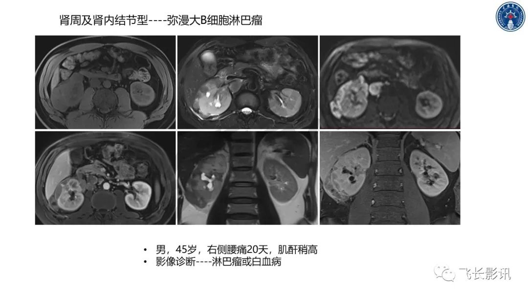 影像PPT - 【PPT】原发性肾淋巴瘤的影像诊断-33