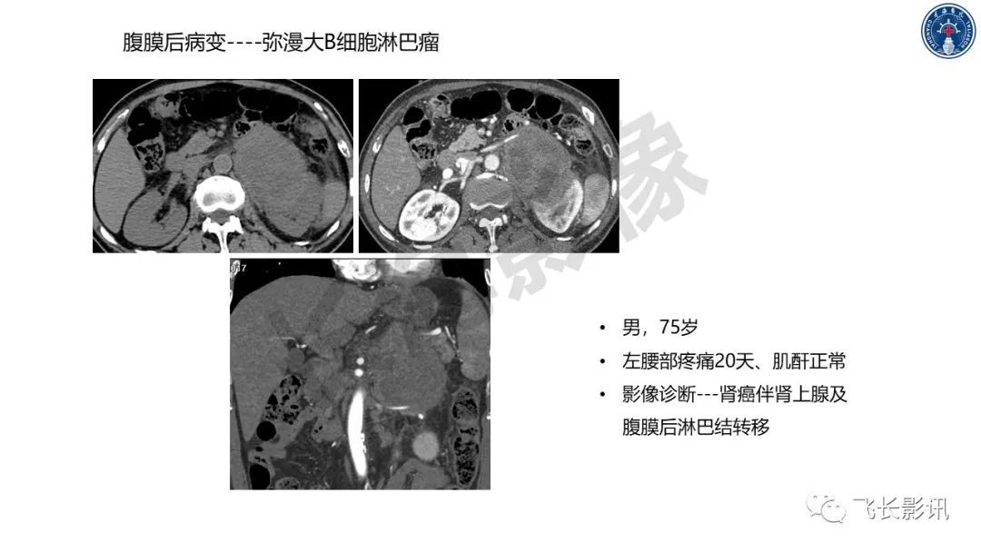影像PPT - 【PPT】原发性肾淋巴瘤的影像诊断-34