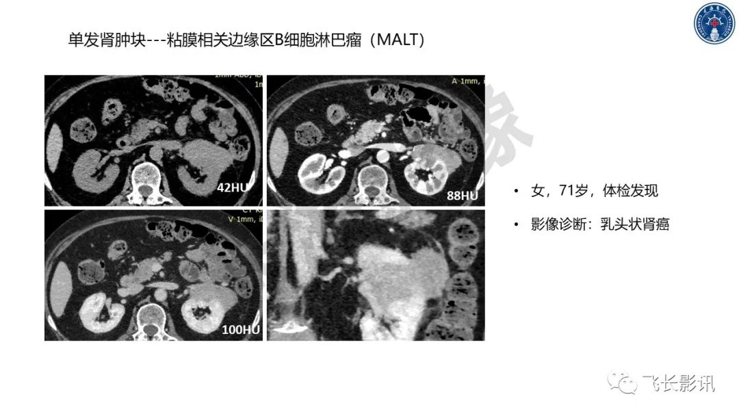 影像PPT - 【PPT】原发性肾淋巴瘤的影像诊断-35