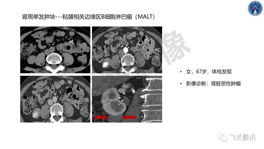 影像PPT - 【PPT】原发性肾淋巴瘤的影像诊断-37