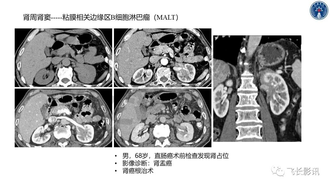 影像PPT - 【PPT】原发性肾淋巴瘤的影像诊断-40