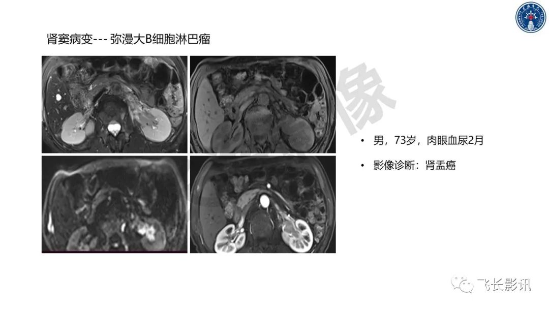 影像PPT - 【PPT】原发性肾淋巴瘤的影像诊断-41
