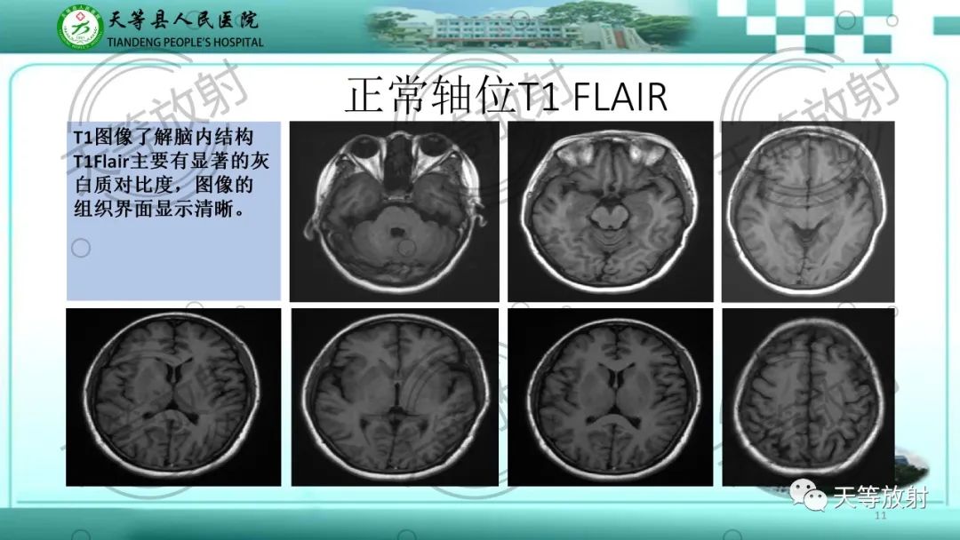 影像PPT - 【PPT】颅内感染疾病磁共振扫描及影像表现-11