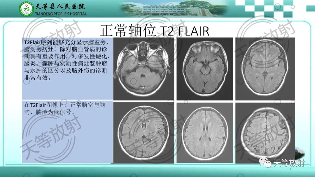 影像PPT - 【PPT】颅内感染疾病磁共振扫描及影像表现-13