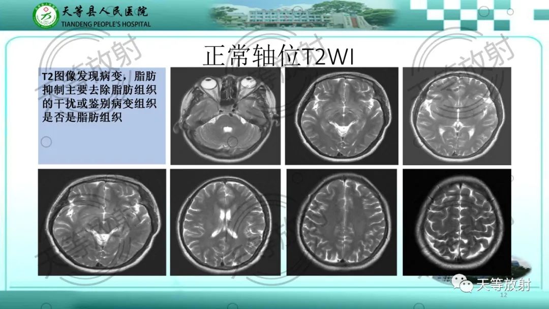 影像PPT - 【PPT】颅内感染疾病磁共振扫描及影像表现-12