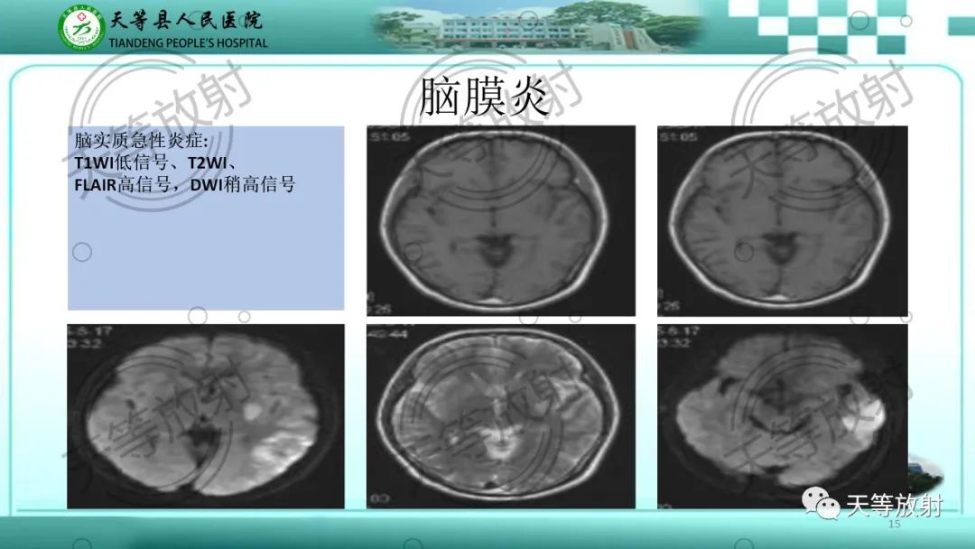 影像PPT - 【PPT】颅内感染疾病磁共振扫描及影像表现-15