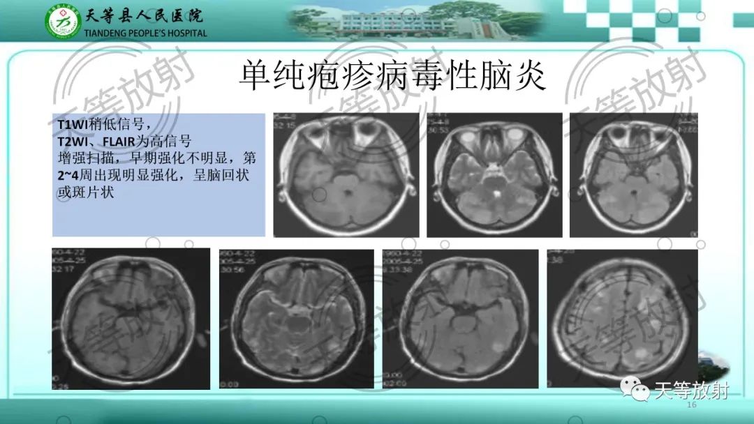 影像PPT - 【PPT】颅内感染疾病磁共振扫描及影像表现-16
