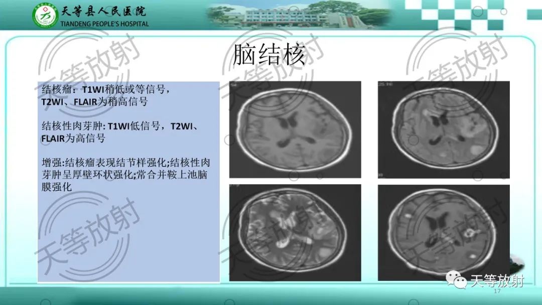 影像PPT - 【PPT】颅内感染疾病磁共振扫描及影像表现-17