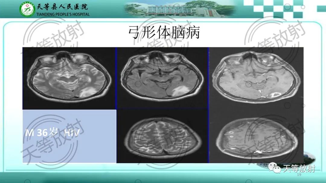影像PPT - 【PPT】颅内感染疾病磁共振扫描及影像表现-19