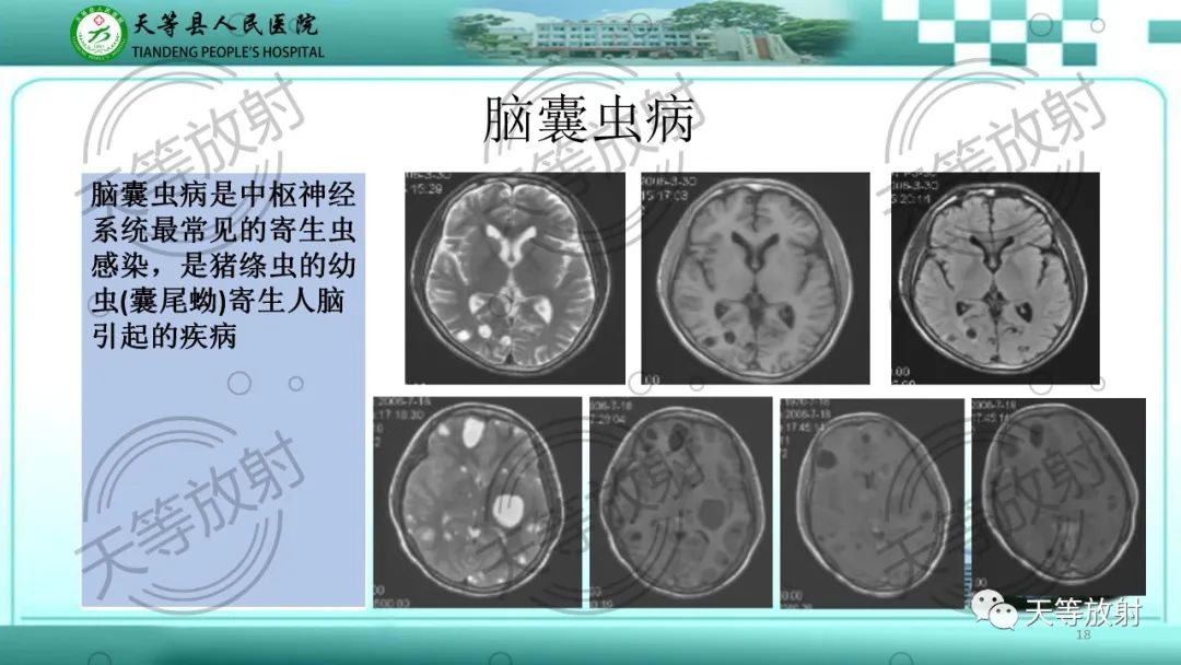 影像PPT - 【PPT】颅内感染疾病磁共振扫描及影像表现-18