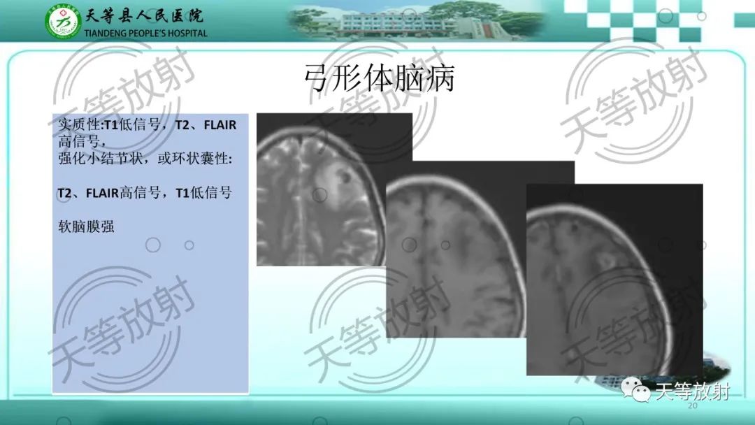 影像PPT - 【PPT】颅内感染疾病磁共振扫描及影像表现-20