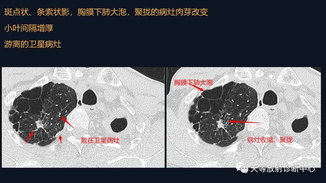 影像PPT - 【病例】肺结核1例CT影像征象分析-2 影像PPT - 【病例】肺结核1例CT影像征象分析-2
