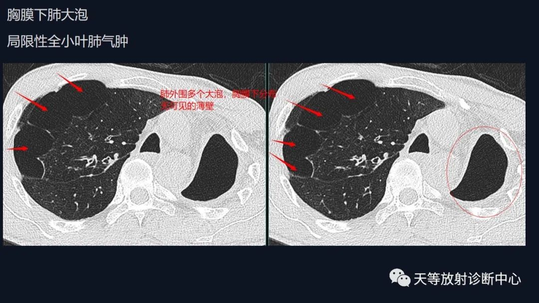 影像PPT - 【病例】肺结核1例CT影像征象分析-3 影像PPT - 【病例】肺结核1例CT影像征象分析-3