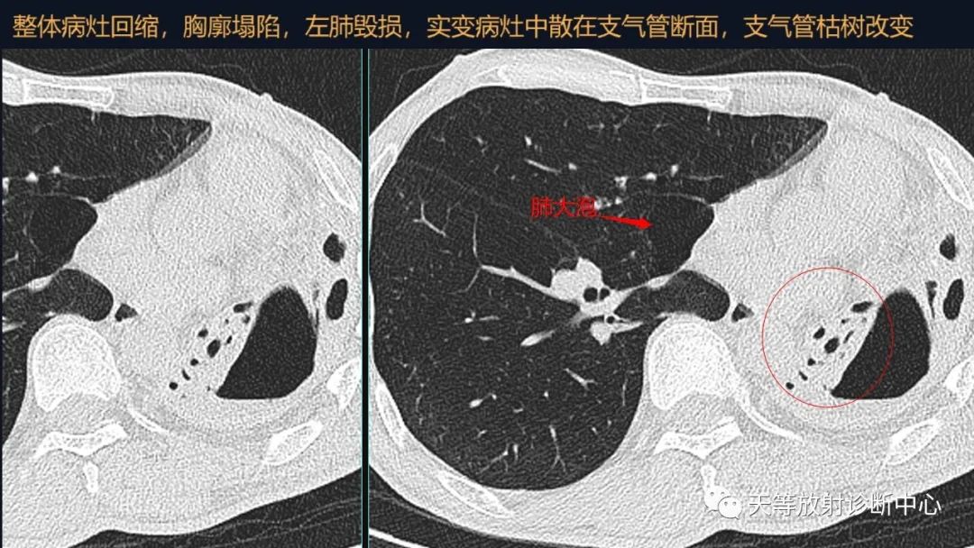影像PPT - 【病例】肺结核1例CT影像征象分析-6 影像PPT - 【病例】肺结核1例CT影像征象分析-6