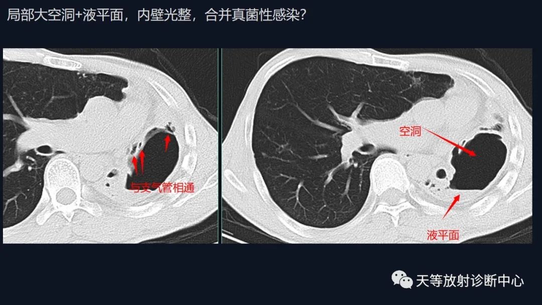 影像PPT - 【病例】肺结核1例CT影像征象分析-7 影像PPT - 【病例】肺结核1例CT影像征象分析-7